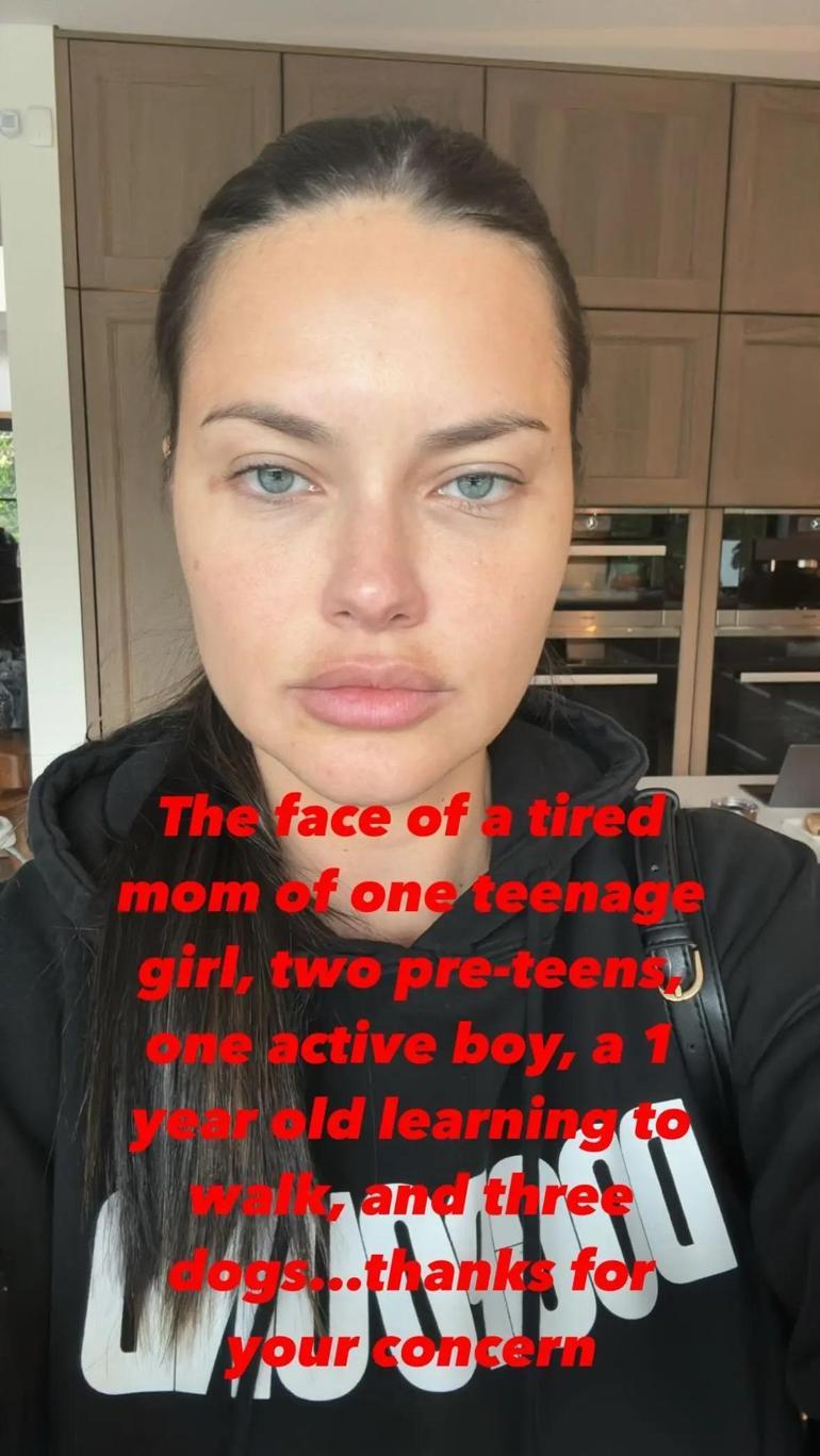 Adriana Lima'nın Estetik Operasyon İddiaları ve Annelik Deneyimi